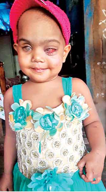 a child eyes Loss After Cancer in visakhapatnam