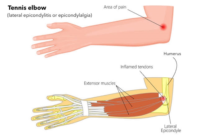 Sachin Tendulkar tennis elbow