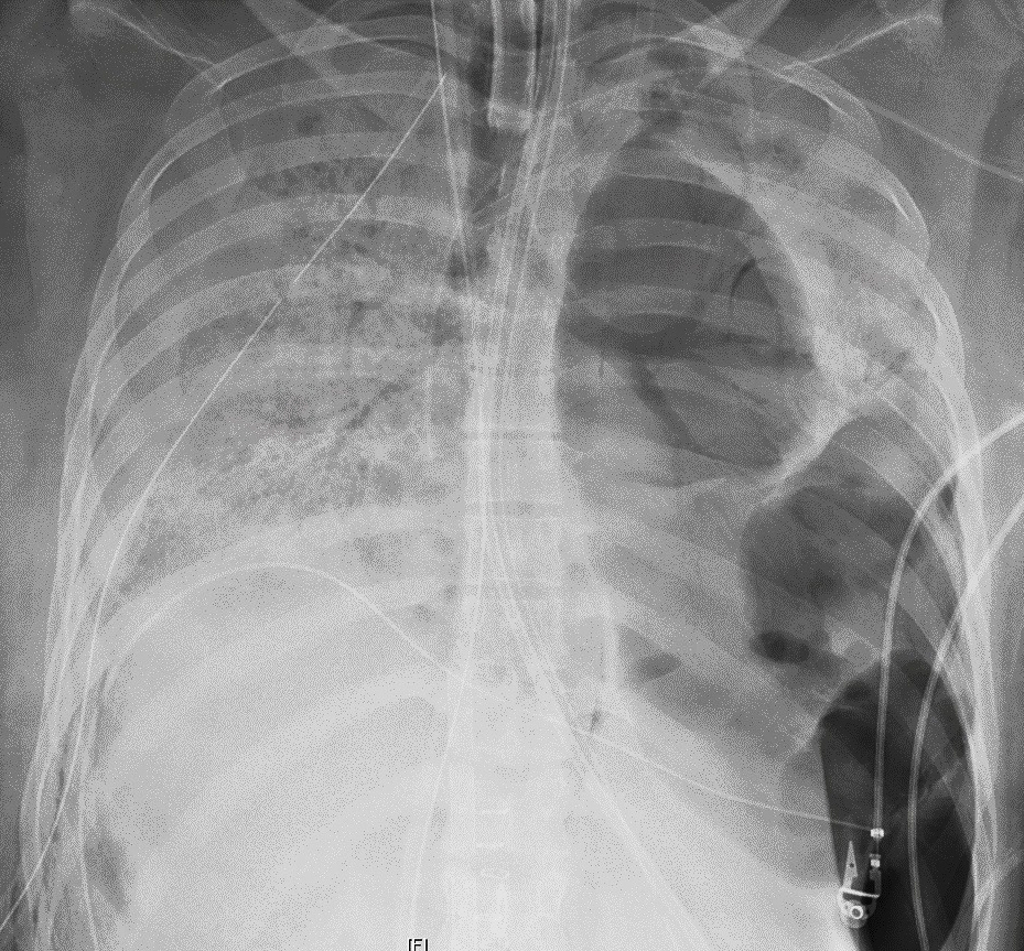 This X-ray image provided by Northwestern Medicine in June 2020 shows the chest of a COVID-19 patient before she received a new set of lungs because of severe lung damage from the coronavirus, at Northwestern Memorial Hospital in Chicago.