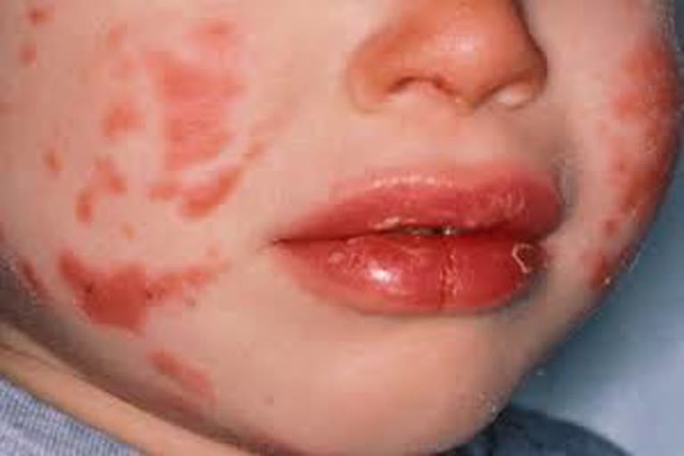 Kawasaki disease