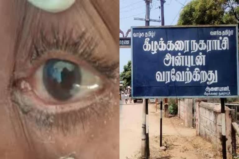 ராமநாதபுரத்தில் முதியவர் கருப்பு பூஞ்சை நோயால் பாதிப்பு 