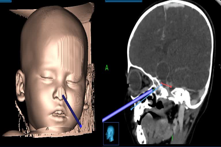 Chandigarh PGI Doctors brain tumor operation