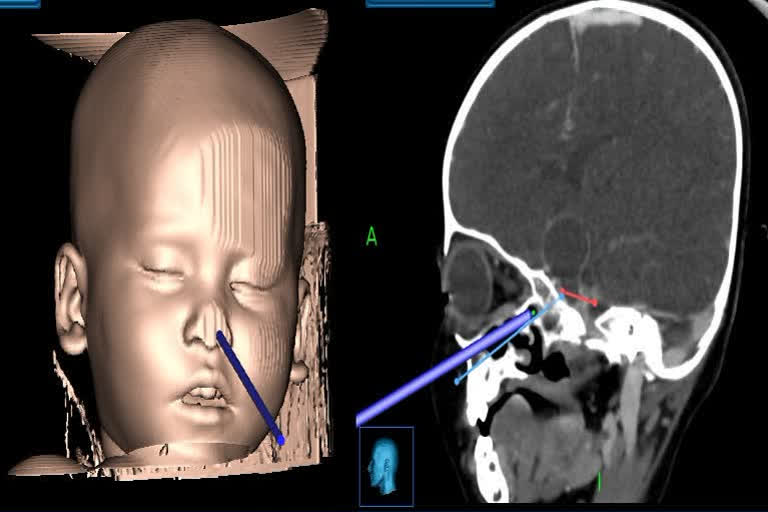 PGIMER doctors remove brain tumour through toddler's nose