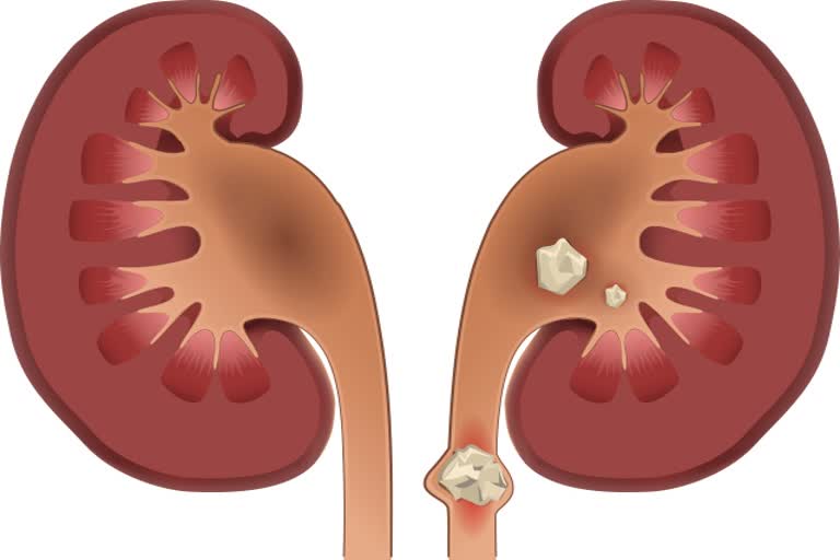 Ayurvedic treatment of kidney stone