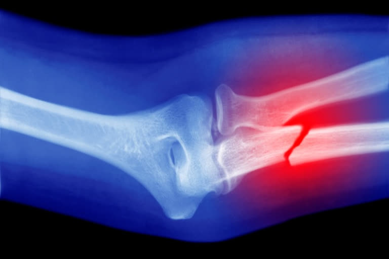 TYPES OF FRACTURE, bone weakness, health