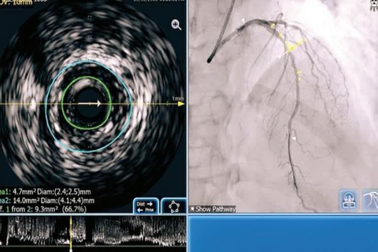 new technique angiography, angiography in AIIMS