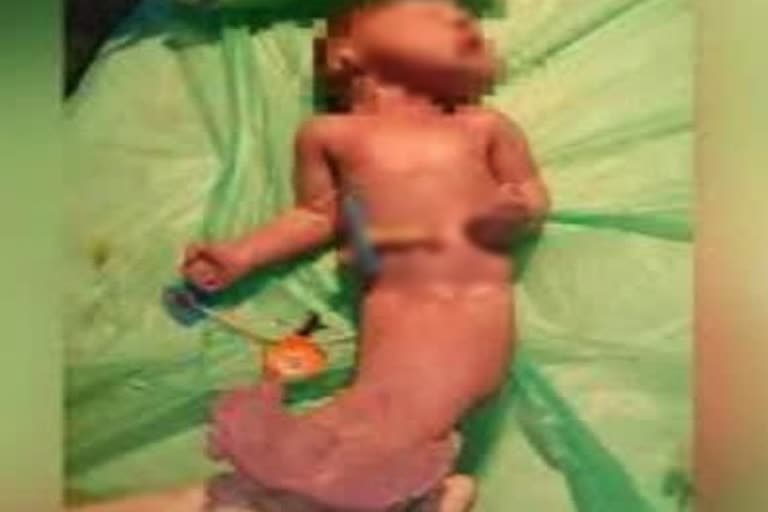 Mermaid shape baby died within 2 hours after birth