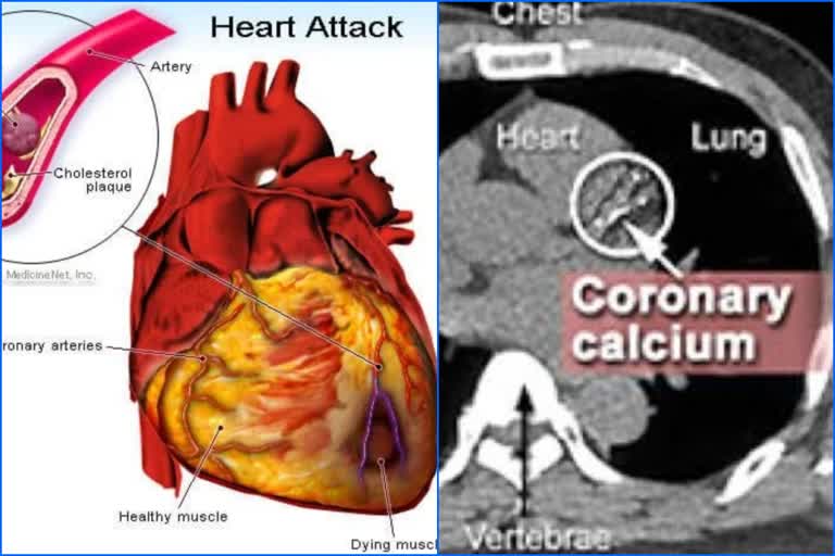 calcium scoring fortis escorts heart institute