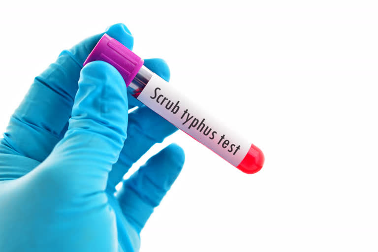  Scrub Typhus, preventing Scrub Typhus, Scrub Typhus diagnosis