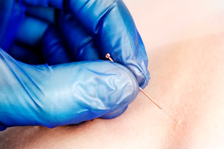 dr needling, dry needling vs acupuncture