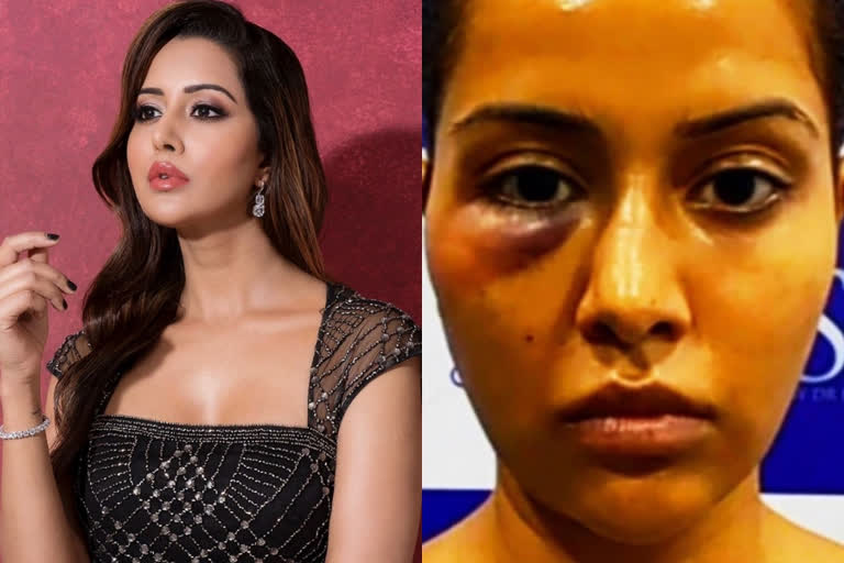 Tamil actor Raiza Wilson says she was Forced to undergo dermatological procedure  ചികിത്സാ പിഴവ്, മുഖം നീരുവന്ന് വീര്‍ത്ത ചിത്രവുമായി നടി റെയ്സ വില്‍സണ്‍  നടി റെയ്സ വില്‍സണ്‍  നടി റെയ്സ വില്‍സണ്‍ വാര്‍ത്തകള്‍  റെയ്സ വില്‍സണ്‍  റെയ്സ വില്‍സണ്‍ സിനിമകള്‍  Raiza Wilson says she was Forced to undergo dermatological procedure  Raiza Wilson news  Raiza Wilson biography