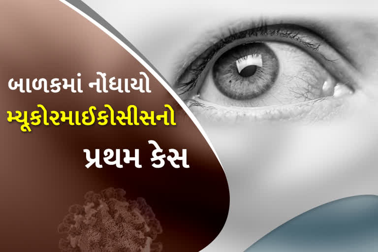 બાળકોમાં મ્યુકોરમાઈકોસીસનો પ્રથમ કેસ, અમદાવાદના 15 વર્ષીય બાળકને દાંતના ભાગે ઈન્ફેક્શન