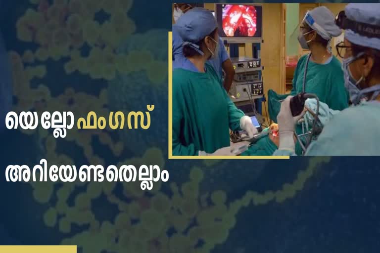 First yellow fungus case reported in Ghaziabad  yellow fungus  Symptoms of yellow fungus  prognosis of yellow fungus  യെല്ലോ ഫംഗസ്  യെല്ലോ ഫംഗസ് ലക്ഷണങ്ങൾ  യെല്ലോ ഫംഗസ് മുൻകരുതലുകൾ