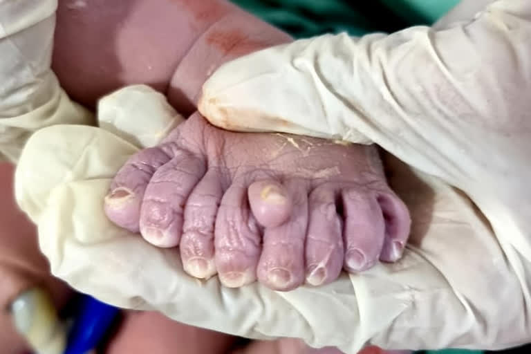 కర్ణాటక హోసపేట వార్తలు, baby born with 9 fingers karnataka