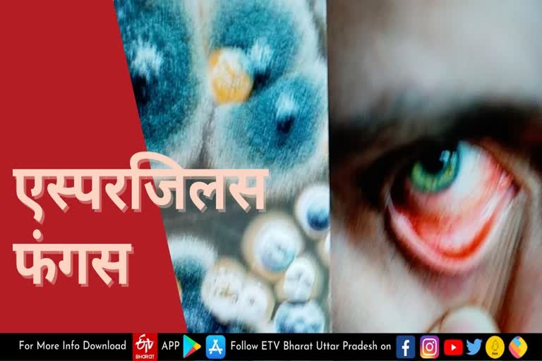 black fungus news  aspergillus fungus news  corona  एसएन मेडिकल कॉलेज आगरा  Aspergillus fungus patient in Agra  आगरा में एस्परजिलस फंगस का मरीज  Confirmation of Aspergillus fungus in a patient of agra  ईएनटी विशेषज्ञ डॉ. अखिल प्रताप सिंह  ENT Specialist Dr Akhil Pratap Singh  आगरा समाचार  ब्लैक फंगस  एस्परजिलस फंगस  Aspergillus fungus patient admitted in SNMC Agra  एस्परजिलस फंगस का मरीज एसएनएमसी आगरा में भर्ती