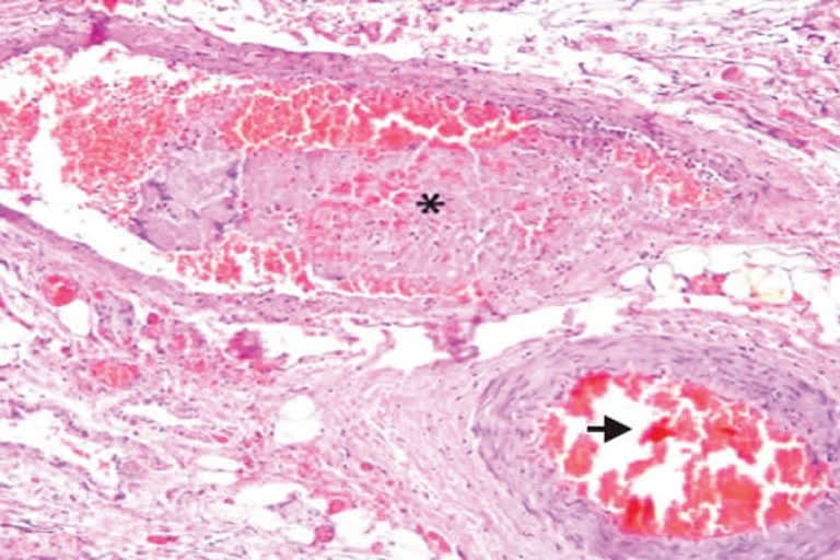 Intestinal gangrene