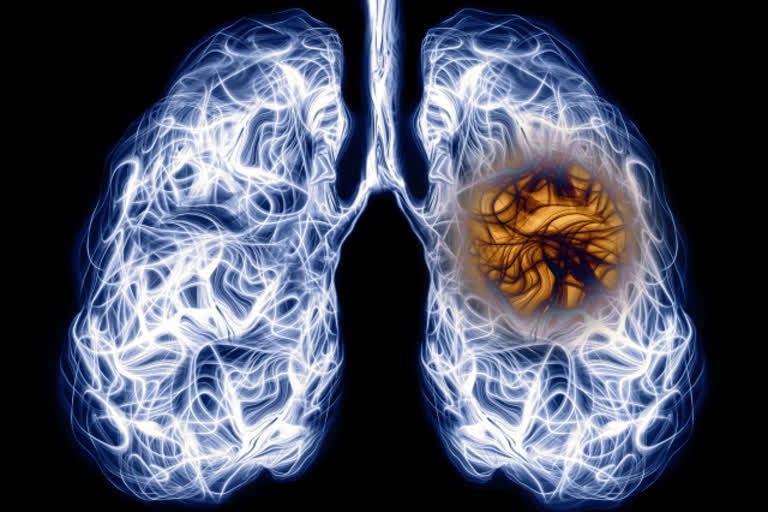 Post Covid Lung Care and Rehabilitation