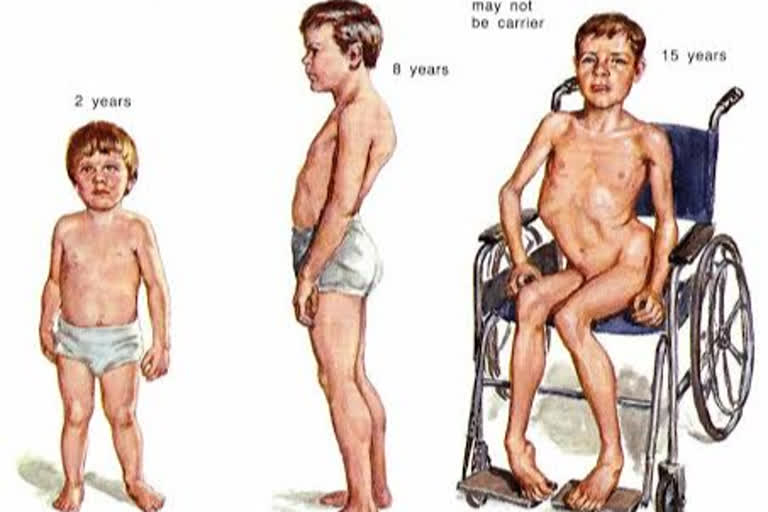 muscular dystrophy