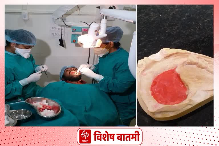 म्युकर मायकोसिसने तोंडातील अवयव गमावलेल्यांना कृत्रिम अवयवांद्वारे नवे आयुष्य!