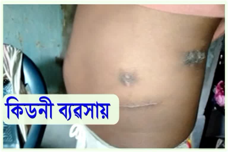 Kidney sold at Dibrugarh