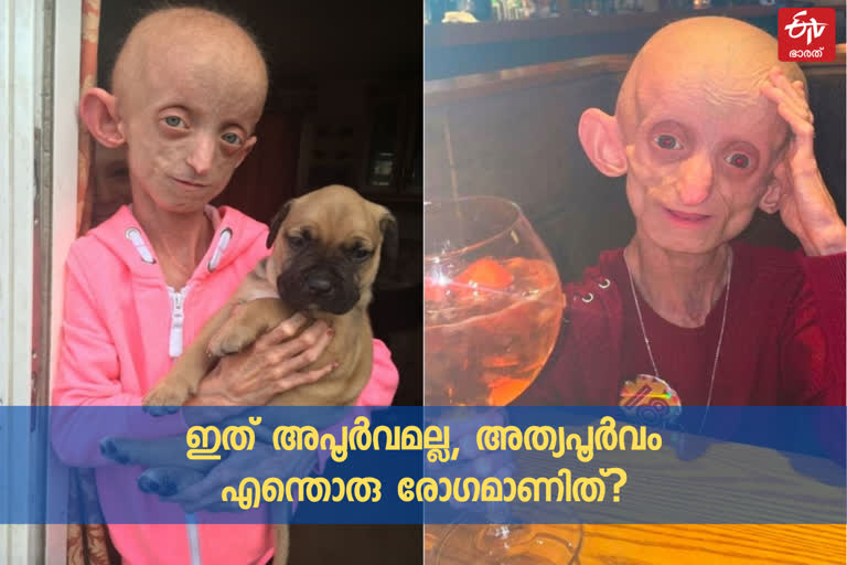 benjamin button disease  asanthi smith dies  ashanthi smith dies  അശാന്തി സ്മിത് മരിച്ചു  ബെഞ്ചമിൻ ബട്ടൺ രോഗം  അശാന്തി സ്മിത്ത് വാർത്ത