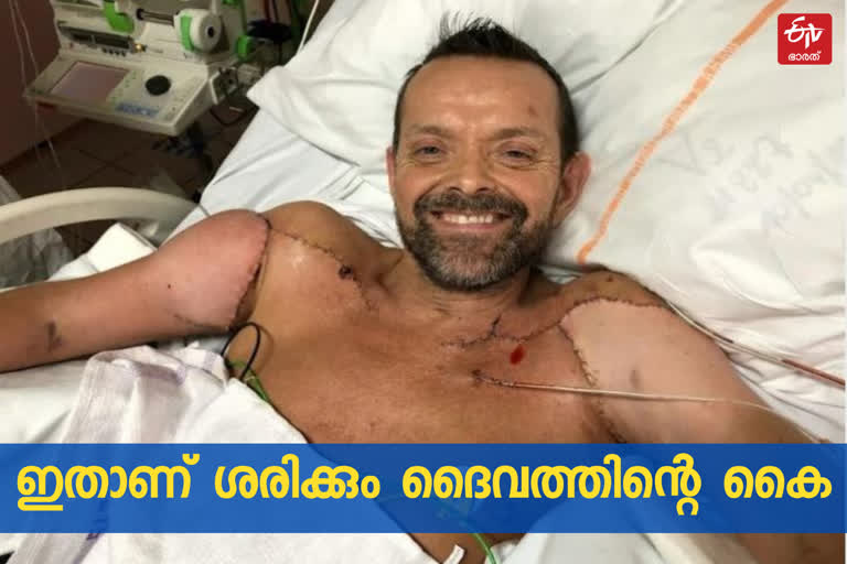 hand replacement surgery  iceland hand replacement surgery  hand replacement surgery news  hand replacement surgery felix iceland  കൈ മാറ്റിവയ്ക്കൽ ശസ്‌ത്രക്രിയ  കൈ മാറ്റിവയ്ക്കൽ ശസ്‌ത്രക്രിയ വാർത്ത  കൈ മാറ്റിവയ്ക്കൽ ശസ്‌ത്രക്രിയ ഐസ്‌ലൻ്ഡ്  കൈ മാറ്റിവയ്ക്കൽ ശസ്‌ത്രക്രിയ ഫെലിക്സ്