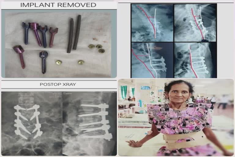 Spine surgery: અમદાવાદ સિવિલમાં માત્ર એક ઓપરેશનથી અઢી વર્ષે રાજકોટના પ્રભાબહેન પીડામુક્ત થયાં