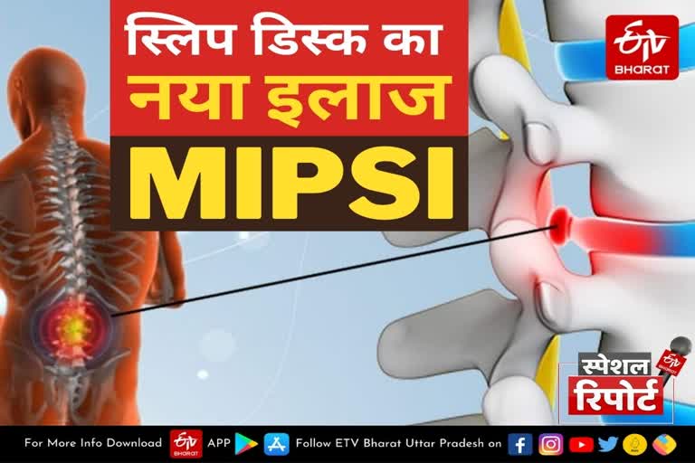 slipped-disc-treatment-with-mipsi-technic-in-lucknow