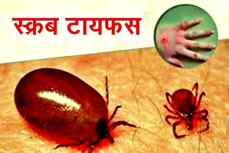 Leptospirosis and typhus fever will now be investigated in Surguja Medical College
