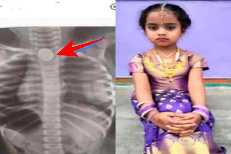 Child died after swallowing a 5 rupee coin