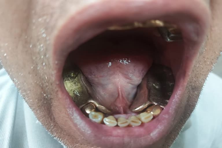 gold in mouth