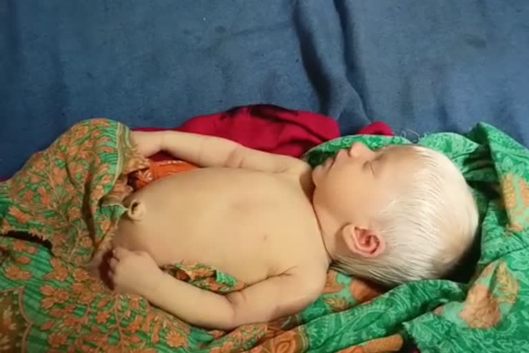 white haired baby born in JLNMCH bhagalpur