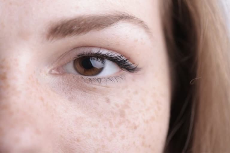 how to get rid of freckles, freckles, what are freckles, home remedies for freckles, skin care, how to treat freckles, why do i have freckles, hormones, are freckles harmful, फ्रेकल्स