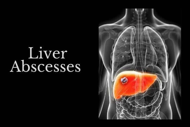 what is Liver Abscesses, how is covid causing Liver Abscesses, Liver Abscesses, liver, health, Liver Abscesses causes, bacterial infections, Amoebiasis, Diseases in India, common diseases in India, COVID19, covid, coronavirus, side effects of covid, covid after effects