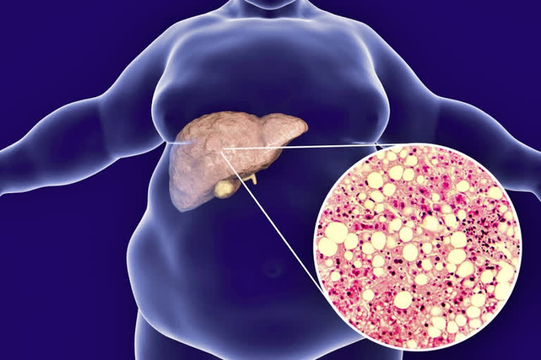 Fatty Liver Disease