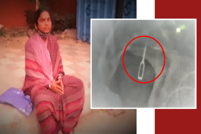 A needle in the woman vertebrae for four years at siricilla