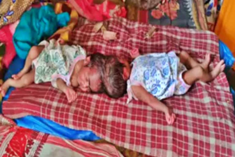 Assam woman gives birth to conjoined twins