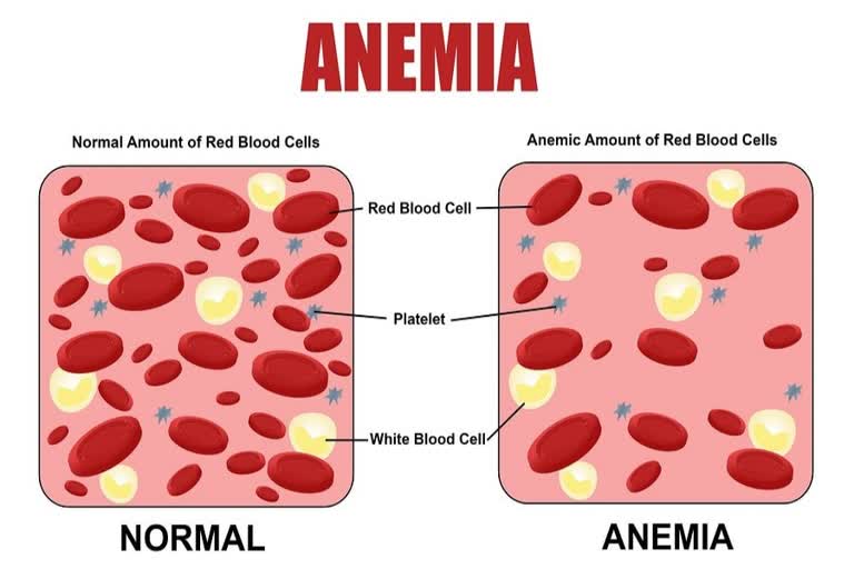 Anemia in Children in bengal