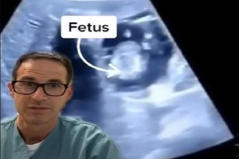 Fetus inside liver, లివర్​లో గర్భం