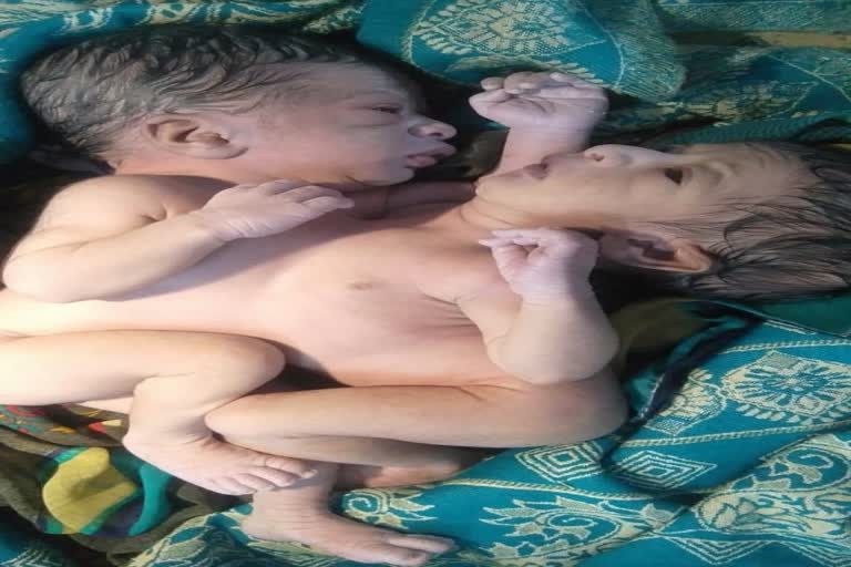 पेट से जुड़ी दो जुड़वा बच्चियों का जन्म