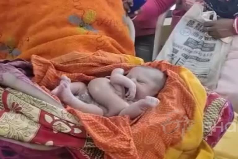 Unique Child Born in Katihar