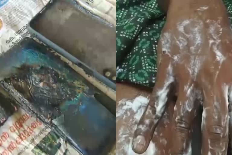 mobile phone explodes  boy injured mobile phone explodes  മൊബൈൽ ഫോൺ പൊട്ടിത്തെറിച്ചു  മൊബൈൽ ഫോൺ പൊട്ടിത്തെറിച്ച് വിദ്യാർഥിക്ക് പരിക്ക്