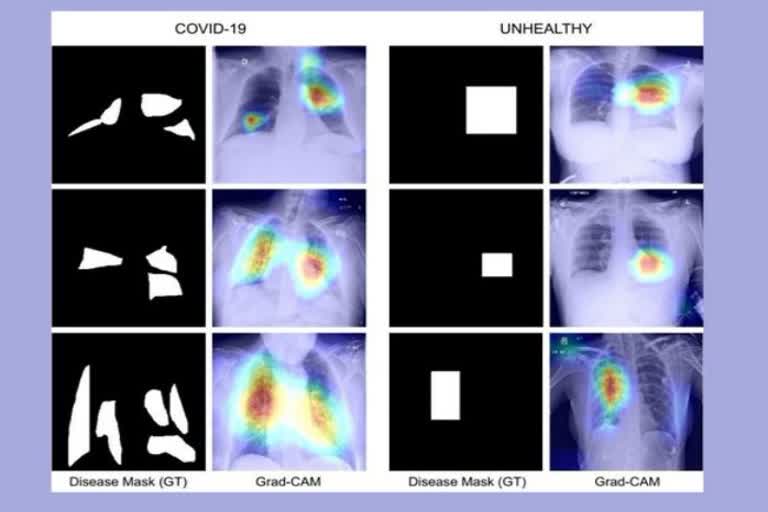 Jodhapur IIT Research: ଚେଷ୍ଟ X-rayରୁ ଧରାପଡିବ କୋଭିଡ