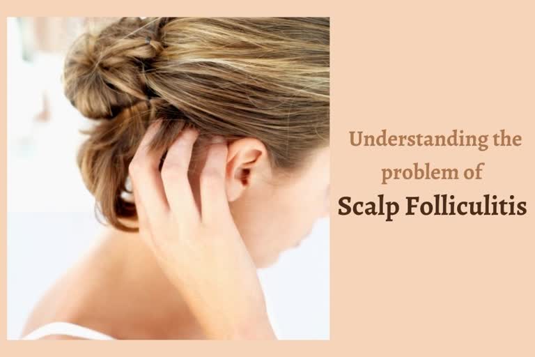 Understanding the problem of Scalp Folliculitis, hair care tips, causes of an itchy scalp, what is scalp folliculitis, what are the causes of scalp folliculitis, how to prevent scalp folliculitis, hair care tips