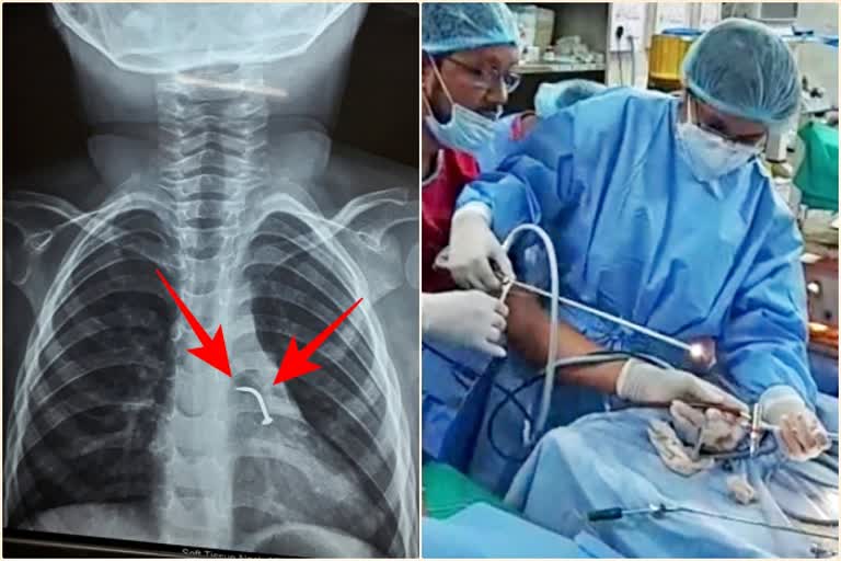 Rare surgery in NBMCH: nail stuck in kid's throat removed