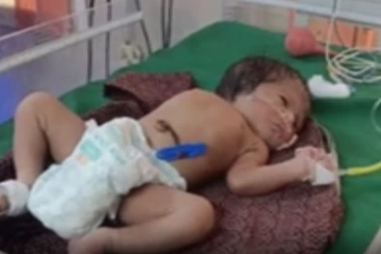 Woman gives birth to baby without ears