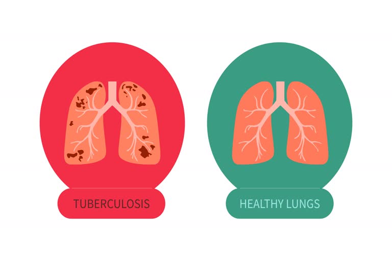 World Tuberculosis Day 2022  what are the symptoms of tb  what is tuberculosis  how is tb treated  how is tuberculosis diagnosed  ലോക ക്ഷയരോഗ ദിനം  എന്താണ് ക്ഷയരോഗം  ക്ഷയരോഗം ലക്ഷണങ്ങള്‍  ടിബി രോഗനിർണയം എങ്ങനെ  ക്ഷയരോഗം ചികിത്സ എങ്ങനെ