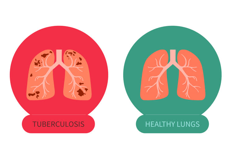 World Tuberculosis Day