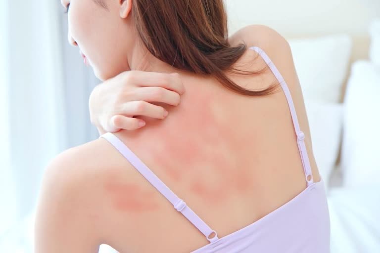 घरेलू नुस्खों से पाएं घमौरियों की समस्या में राहत, what are the home remedies for heat rashes, what are heat rashes, what causes heat rashes, skin care tips