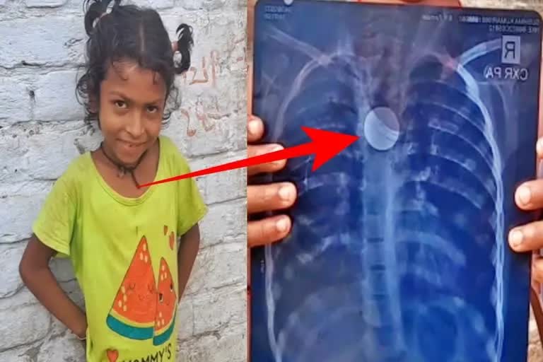Two Rupee Coin stuck in Girl Chest